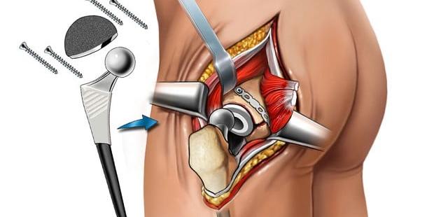  Doctors seeing 30% rise in hip surgeries in young patients post pandemic