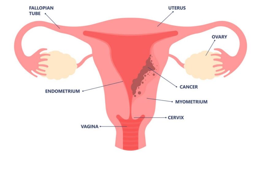  Testosterone shows promise to treat endometrial cancer: Study