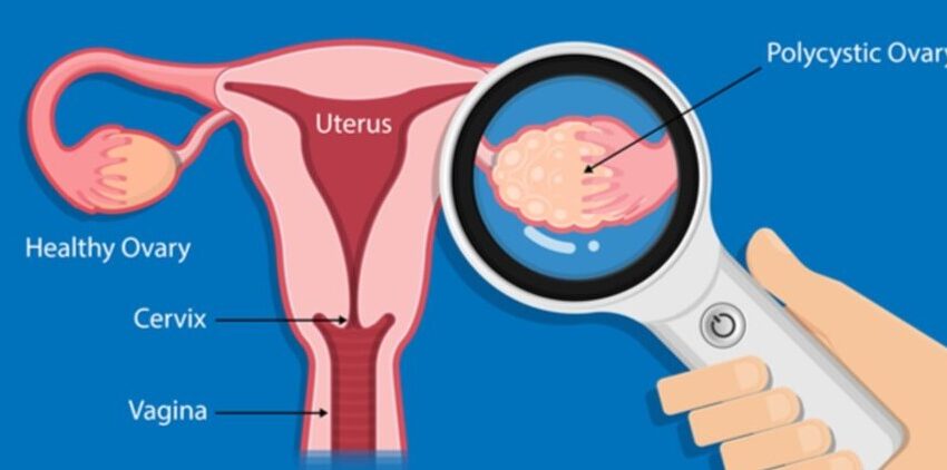  Stem cell-derived components may help treat PCOS