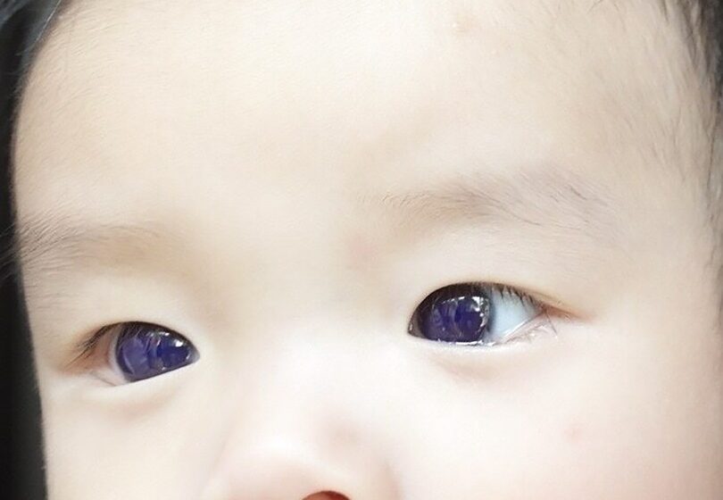  Covid antiviral turns Thai baby’s brown eyes blue