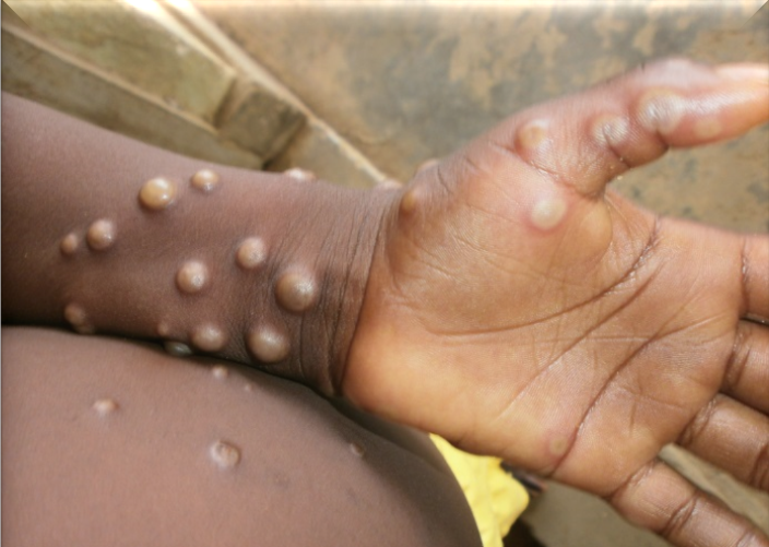  11% mpox patients also had eye diseases: Study