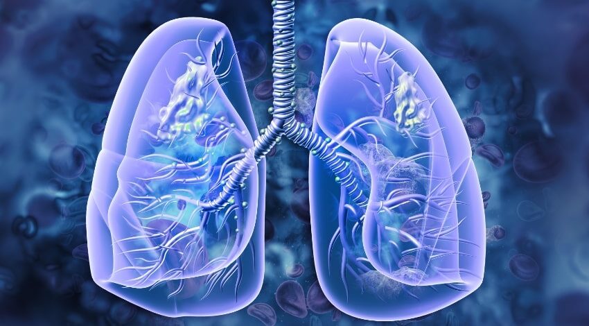  Covid deaths may be linked to a fatal lung disease: Scientists