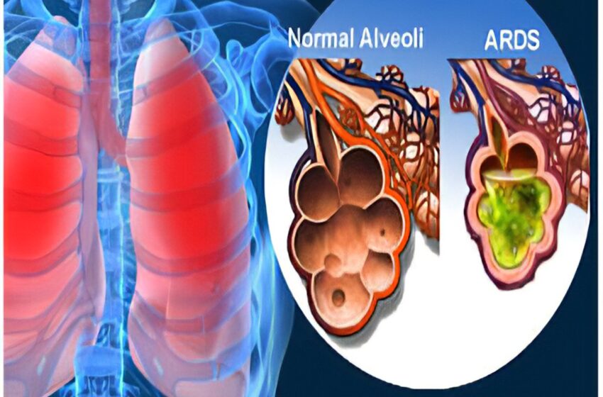  New cell therapy shows promise for Covid-related respiratory distress