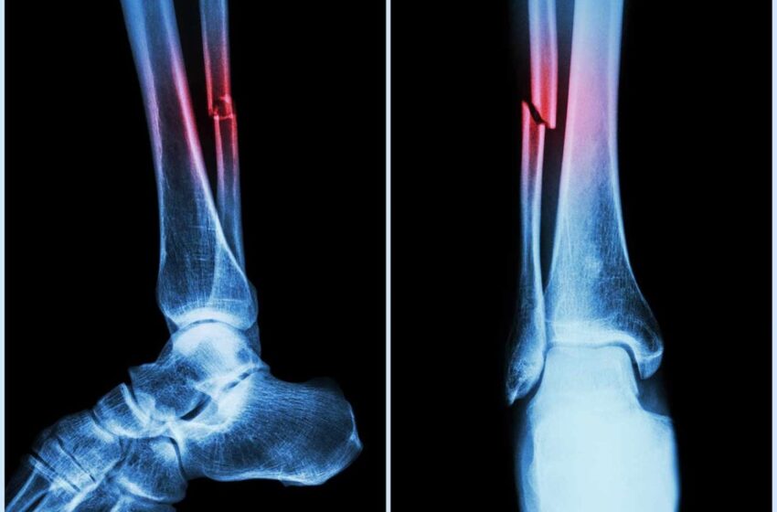  Can AI help patients with bone fractures?